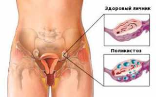 Можно ли забеременеть при поликистозе яичников?