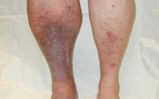 Как выглядят тромбы в ноге: симптомы и лечение опасного заболевания