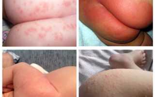 Аллергия на памперсы у ребенка: фото, может ли быть, симптомы у мальчиков и девочек