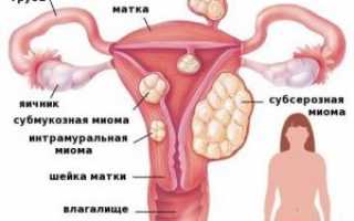 Может ли миома самостоятельно рассосаться