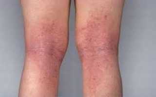 Пятна на ногах — косметический дефект или признак заболевания?