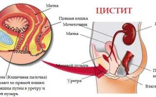 Быстрая помощь при цистите