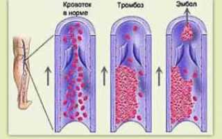 Симптомы и методики лечения тромбоза глубоких и поверхностных вен нижних конечностей
