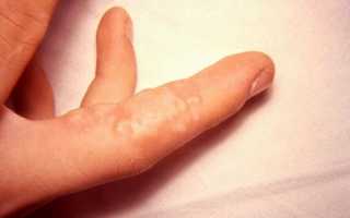 Пузырьки на пальцах рук: от чего появляются волдыри на коже