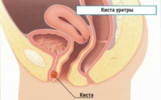 Парауретральная киста