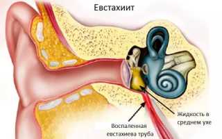 Что такое евстахиит и как его лечить?