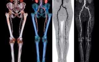 Нарушение кровообращения нижних конечностей: симптомы и лечение