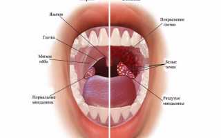 Может ли быть фолликулярная ангина без температуры, как ее лечить
