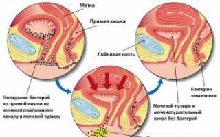 Лечение острого цистита