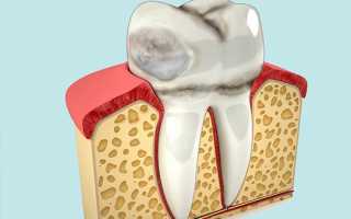Эрозия зубной эмали: фото, МКБ-10, причины, лечение и диагностика
