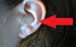 Как убрать серную пробку в домашних условиях и не повредить ухо?