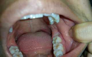 Зуб мудрости: удаление или лечение? Цена, фото и последствия