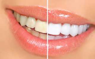 Отбеливание зубов: лучшие решения, виды и цены, отзывы, домашнее отбеливание
