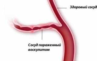 Геморрагический васкулит: причины, симптомы и лечение пурпуры Шенлейн-Геноха
