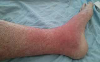 Аллергия на ногах: как проявляется и почему чешутся красные пятна на коже