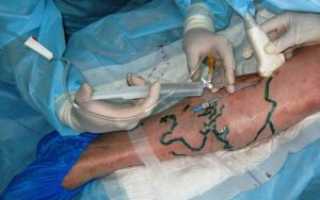 Какую операцию по удалению варикоза предпочесть — как происходит хирургическое удаление варикозных вен