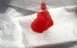 О чем говорит кровь на туалетной бумаге после дефекации и что делать?