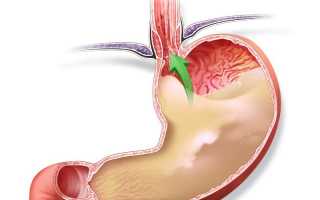 Симптомы и лечение повышенной кислотности желудка