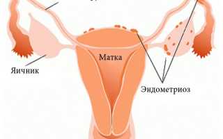 Лечение эндометриоза без гормонотерапии