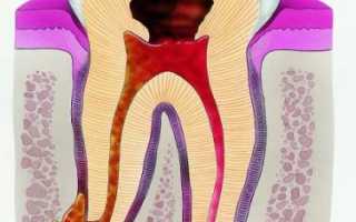 Гранулема зуба: фото, симптомы, удаление и лечение