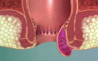 Когда необходима и как проводится тромбэктомия геморроидального узла