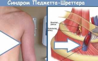 Причины, симптомы и лечение тромбоза глубоких вен плеча