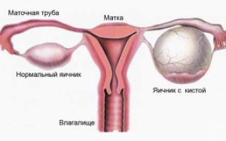 Почему возникает кистома яичников и как с ней бороться