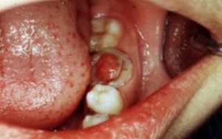 Пульпит зуба: что это такое, как лечить? Фото, симптомы