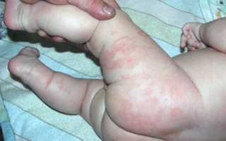 Аллергия на ногах у ребенка: как вылечить сыпь и красные пятна на коже