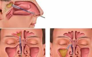 Прокол гайморовых пазух, лечение после прокола и возможные осложнения
