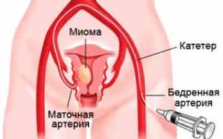 Миома матки лечение без операции