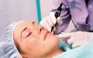 Как предотвратить купероз на лице — профилактика и лечение болезни, отзывы и цены процедур