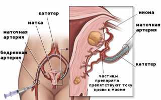 Лечение миомы матки малых размеров