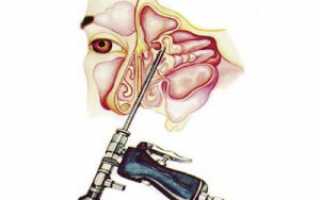 Как делают прокол при гайморите: показания к процедуре и основные моменты ее проведения