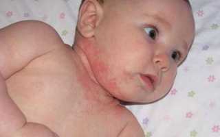 Аллергия у грудничка на лице и теле: как выглядит и как лечить, фото