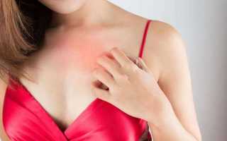 Раздражение под грудью: как лечить высыпание под грудными железами у женщин