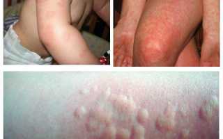Виды аллергии на коже: фото с описанием у детей и взрослых