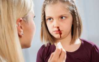 Почему у детей идет кровь из носа, общие и местные причины явления