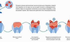 Кариес зубов: фото, стадии, лечение